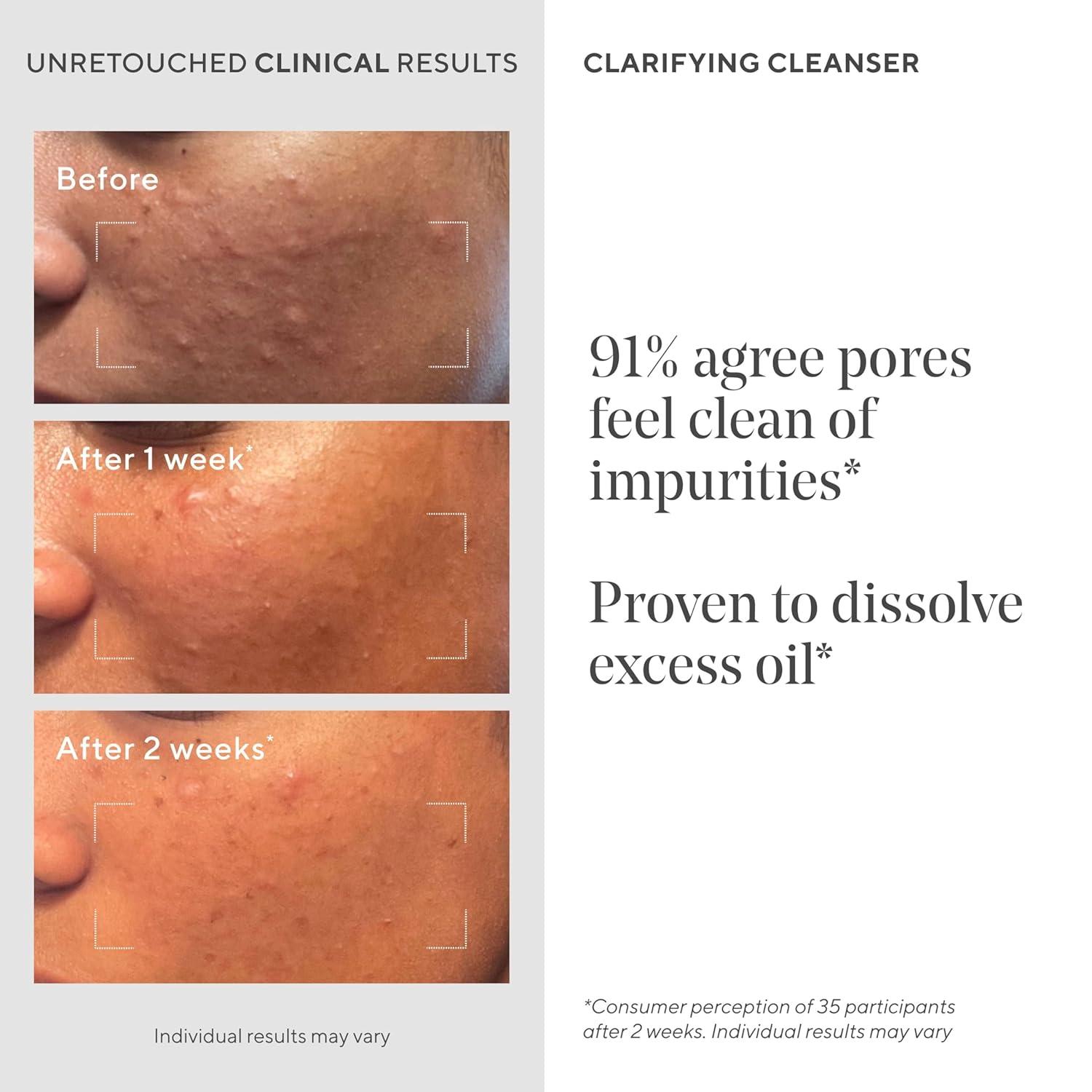 imageMurad Acne Control Clarifying Cleanser Salicylic Acid ampamp Green Tea Formula for Acne Deep Pore Cleansing Oil Control ampamp Breakout Prevention for Clear Balanced HealthyLooking Skin5 Fl Oz