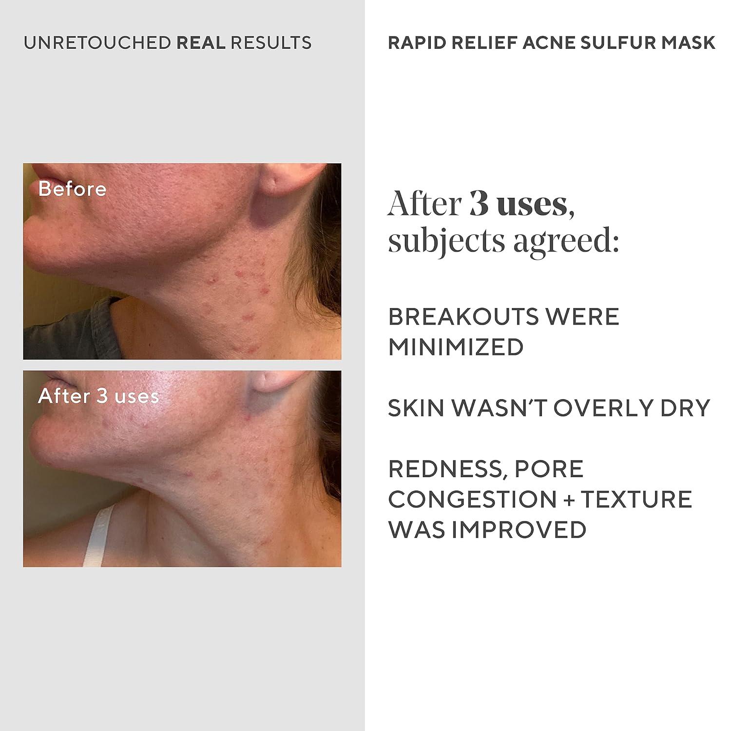 imageMurad Acne Control Rapid Relief Acne Sulfur Mask 25Fl Oz