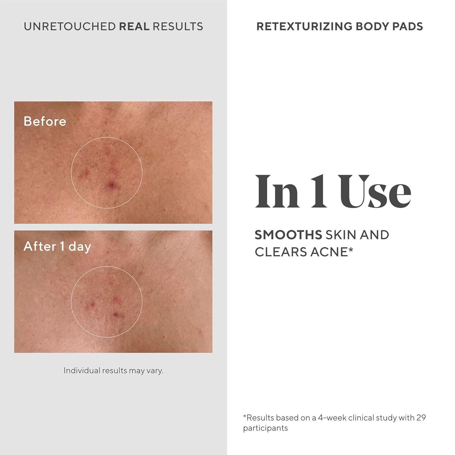 imageMurad Retexturizing Body Pads AcneFighting Exfoliating Pads with Azelaic Salicylic and Glycolic Acid for Acne Breakouts Smoothing KP Bumps and Soothing Aggravated Skin 45 Pads