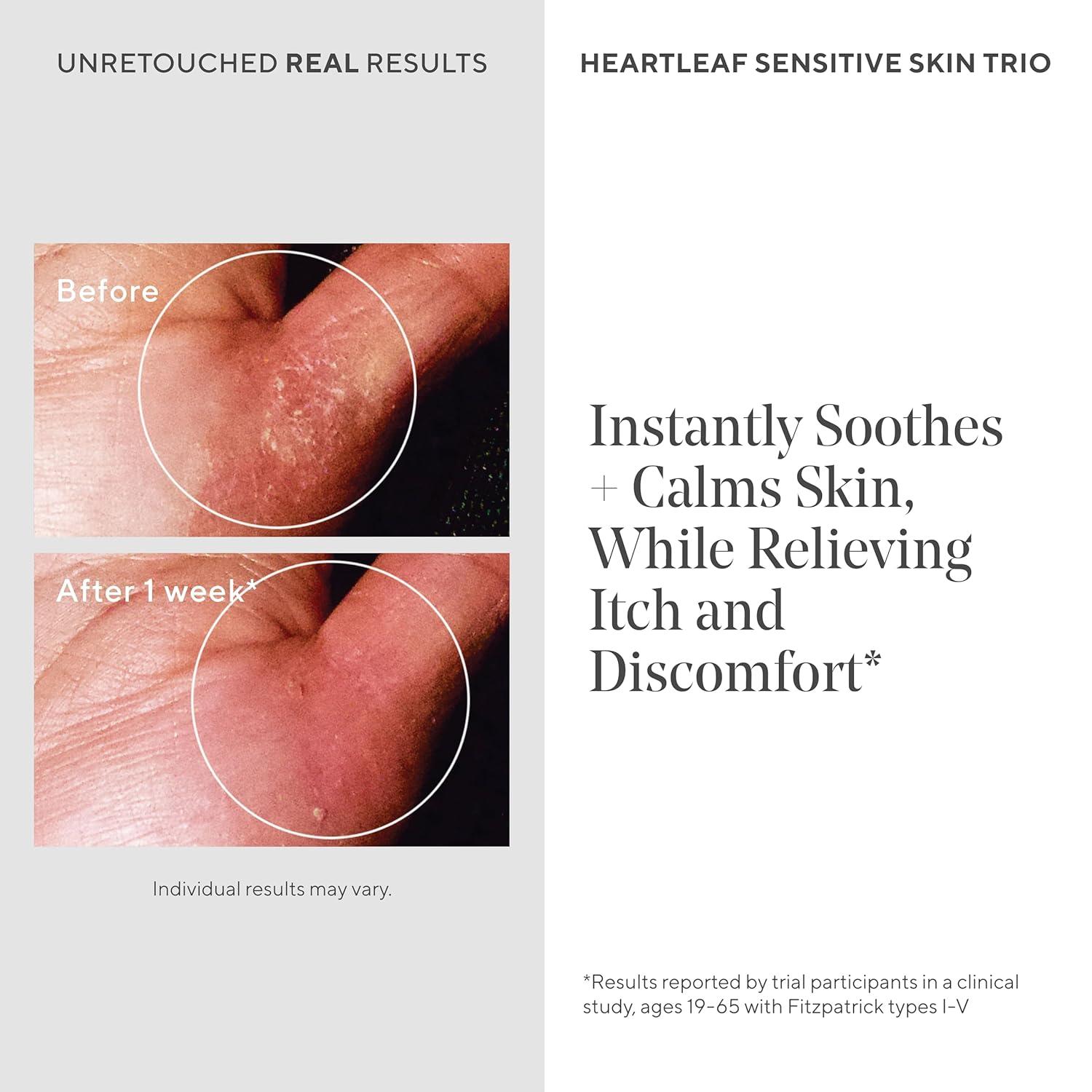 imageMurad Quick Relief Colloidal Oatmeal Treatment 5 Colloidal Oatmeal Cream with Ground Cherry ampamp Oat Lipids for EczemaProne Skin Hydrates Soothes ampamp Relieves Redness Itch Rashes 17 Fl Oz